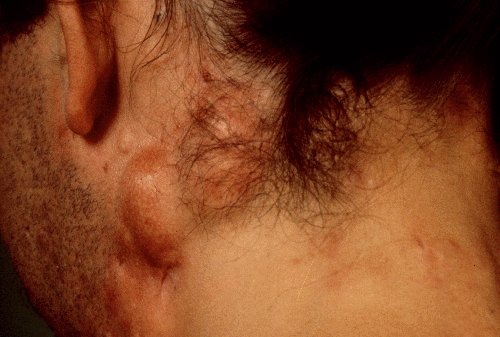 photo of acne conglobata