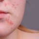 Acne Treatment: Birth Control Pills