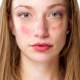 What Causes Acne Flare-ups?
