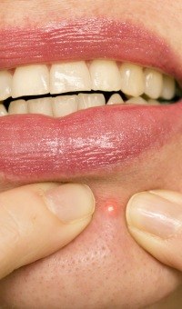 Comprehesive overview of acne