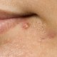 How Accutane works in Acne Treatment