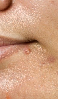 How does Accutane work in Acne Treatment?