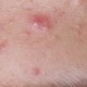 Acne - Treatment Challenges