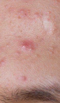 Acne Treatment Challenges