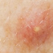 Selecting Appropriate Treatments for Acne