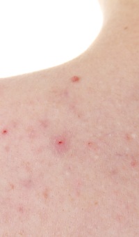 Doxycycline as acne treatment