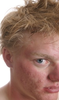 Learn to manage acne prone and oily skin this summer