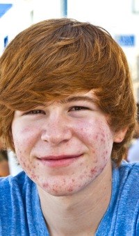Oral Antibiotics in Acne Treatment