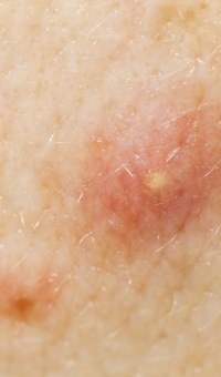 acne basics and facts