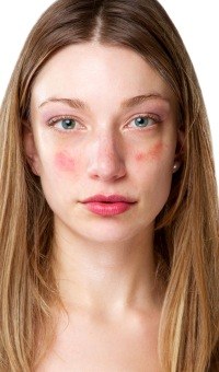 Different types of acne